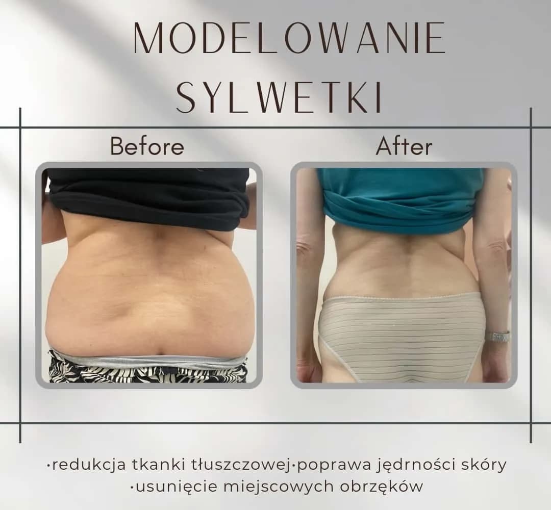 Liposukcja: Modelowanie sylwetki i trwałe efekty. Czy to dla Ciebie?