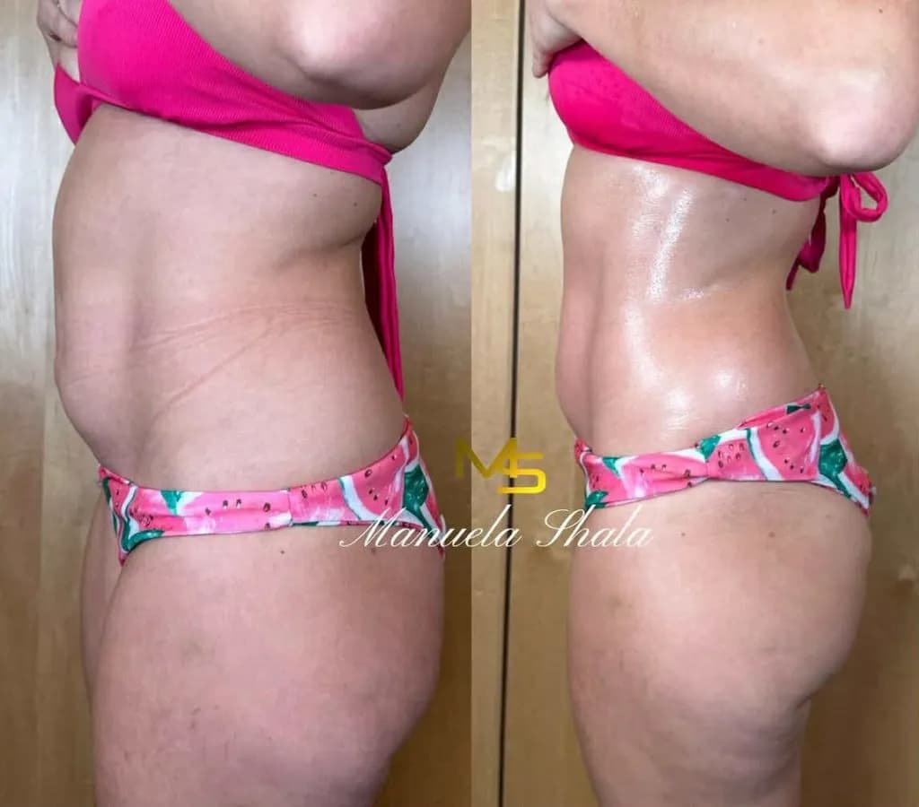 Drenaż limfatyczny: ile zabiegów potrzeba na trwałe efekty?