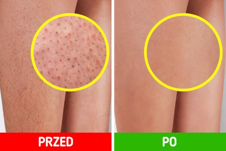 Jak pożegnać „truskawkowe nogi”? Gładka skóra po goleniu!