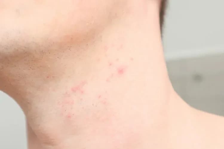 Jak złagodzić podrażnienia po goleniu? Gładka skóra bez krostek!